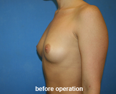 plastic-surgery-breast-augmentation
